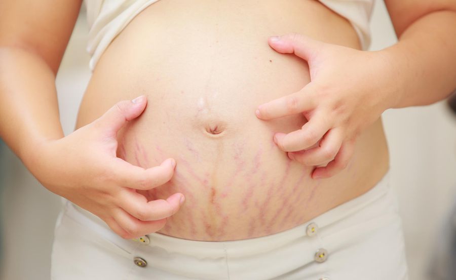 Pregnant Woman Scratching Belly With Stretch Marks